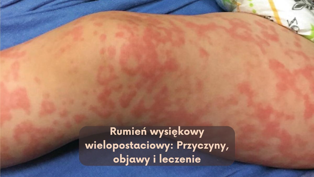 Rumień wysiękowy wielopostaciowy: Przyczyny, objawy i leczenie