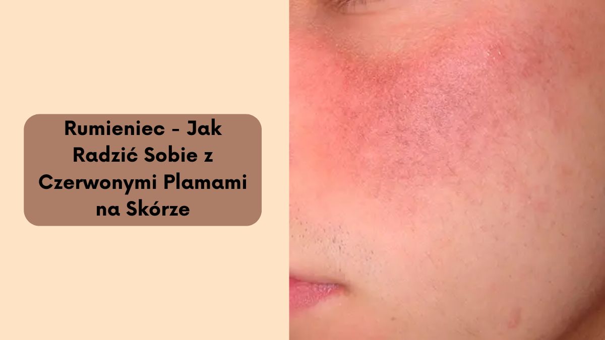Rumieniec – Jak Radzić Sobie z Czerwonymi Plamami na Skórze