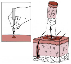 Biopsja skóry