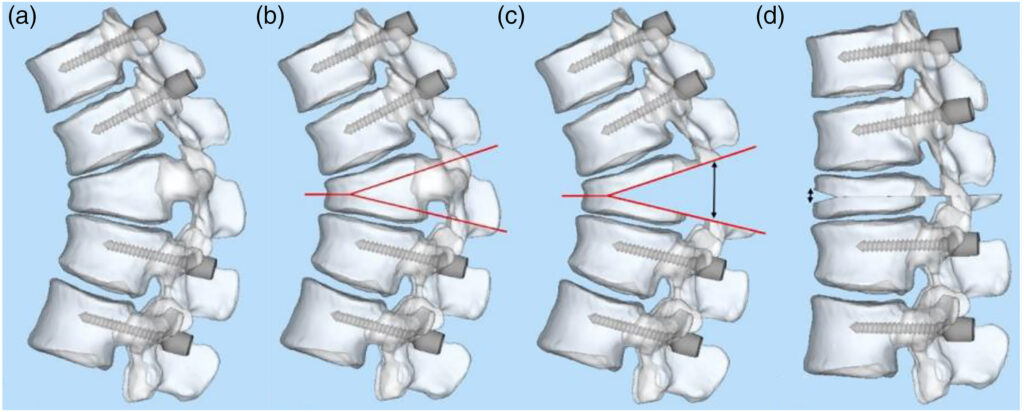 Osteotomia
