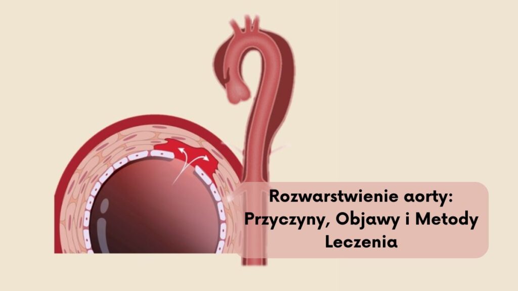 Rozwarstwienie aorty: Przyczyny, Objawy i Metody Leczenia