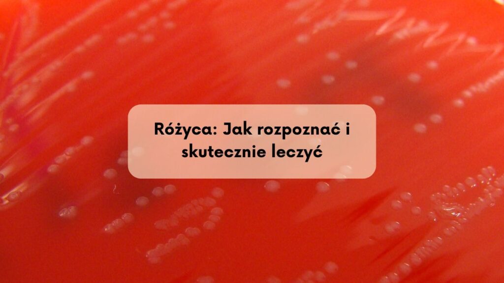 Różyca: Jak rozpoznać i skutecznie leczyć