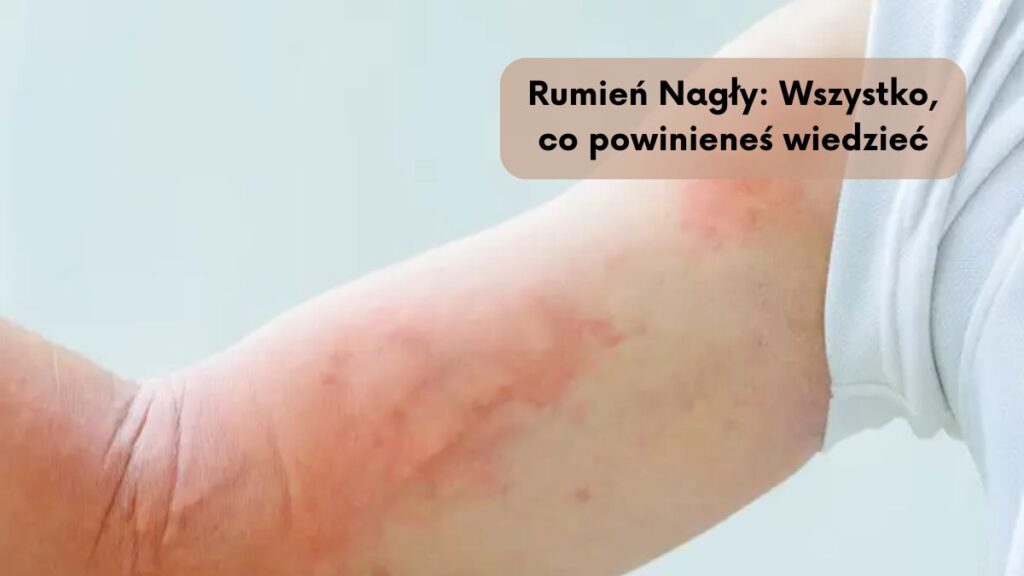 Rumień Nagły: Wszystko, co powinieneś wiedzieć