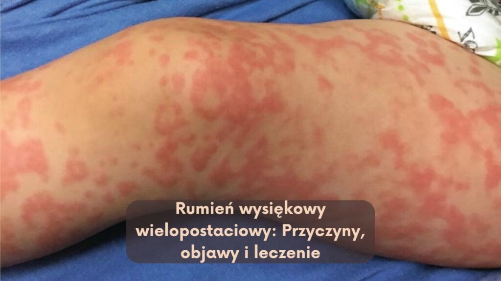 Rumień wysiękowy wielopostaciowy: Przyczyny, objawy i leczenie