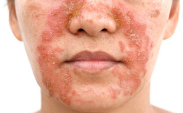 Atopowe zapalenie skóry