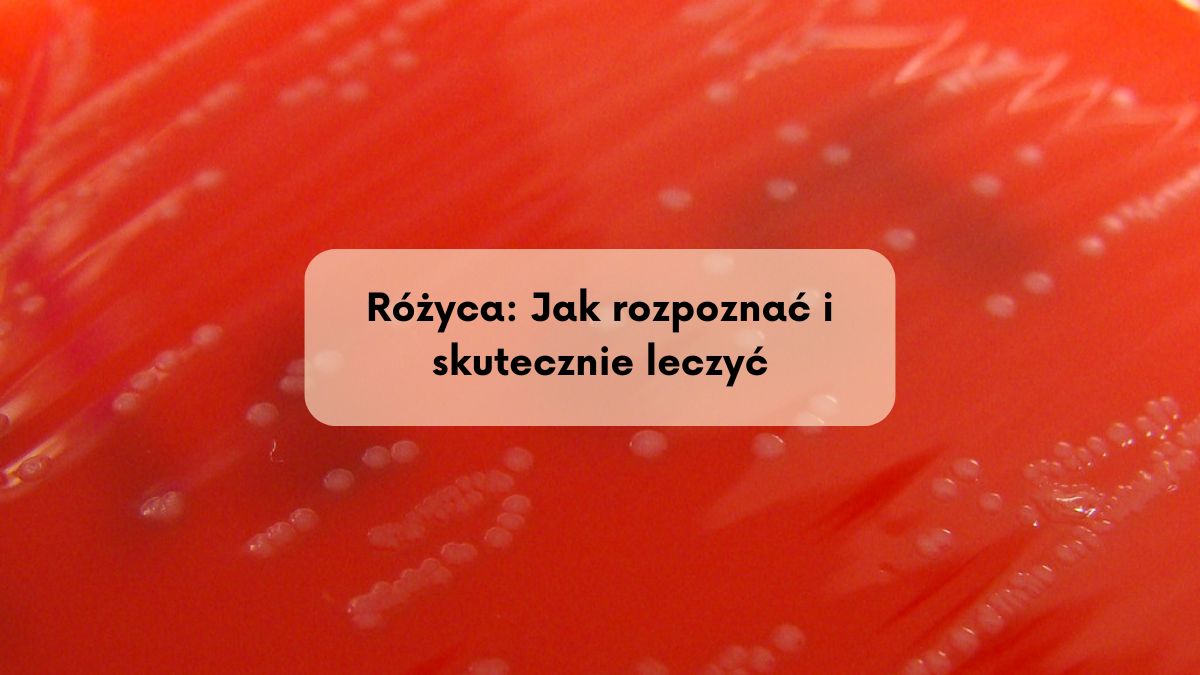 Różyca: Jak rozpoznać i skutecznie leczyć