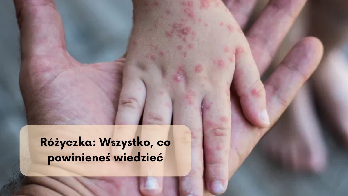 Różyczka: Wszystko, co powinieneś wiedzieć