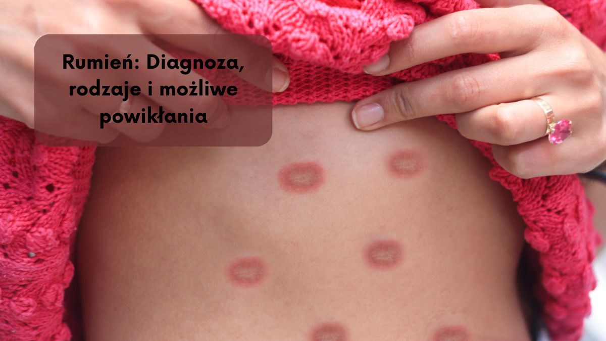Rumień: Diagnoza, rodzaje i możliwe powikłania