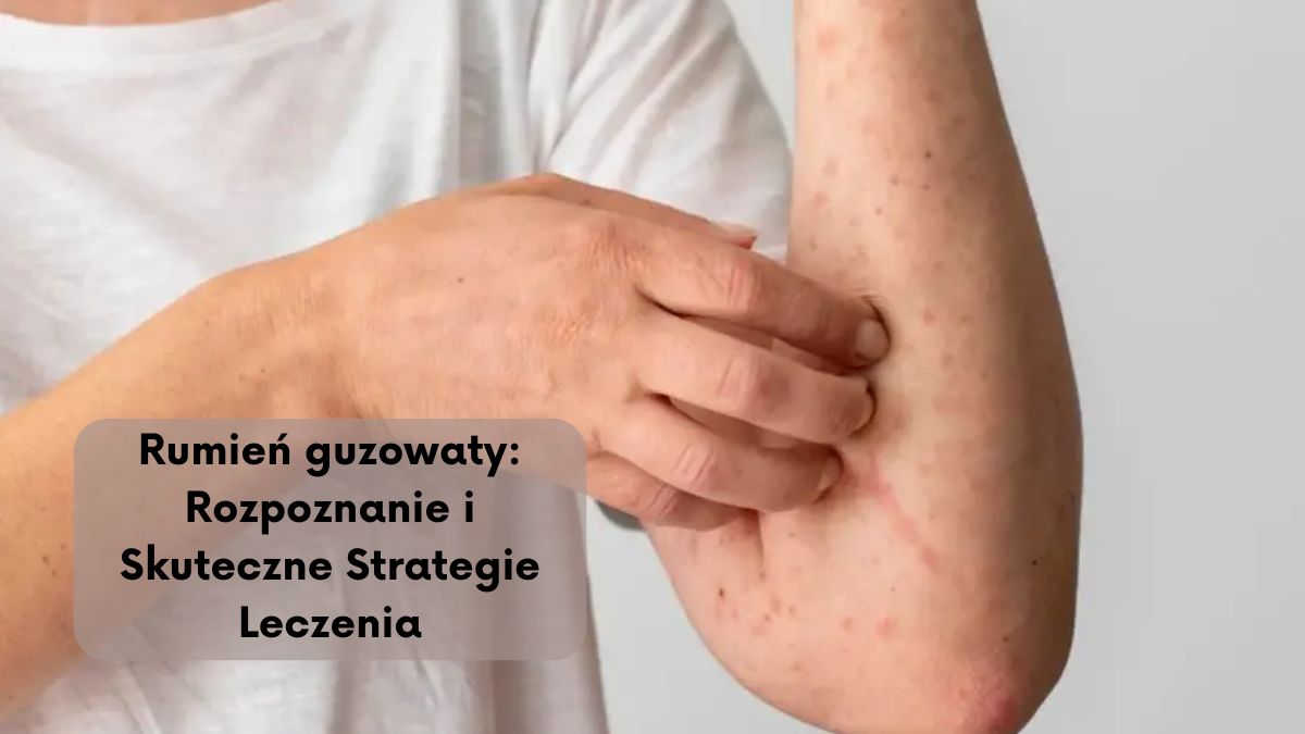 Rumień guzowaty: Rozpoznanie i Skuteczne Strategie Leczenia