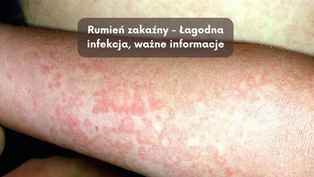 Rumień zakaźny - Łagodna infekcja, ważne informacje