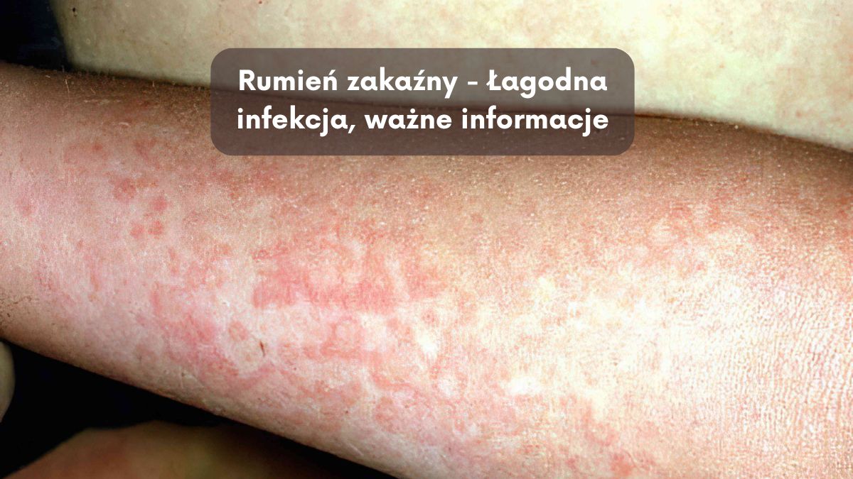 Rumień zakaźny - Łagodna infekcja, ważne informacje