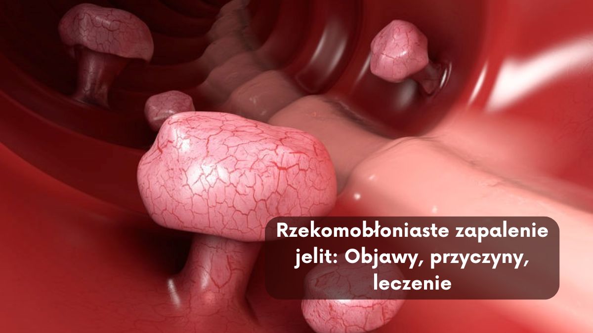 Rzekomobłoniaste zapalenie jelit: Objawy, przyczyny, leczenie