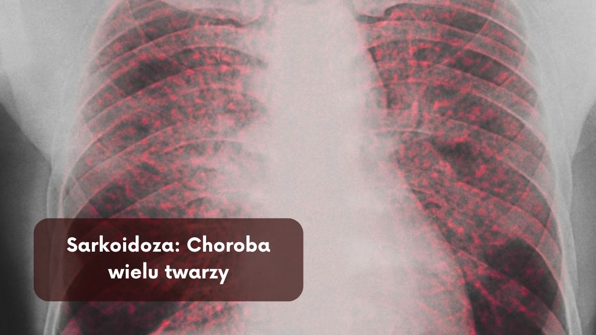 Sarkoidoza: Choroba wielu twarzy