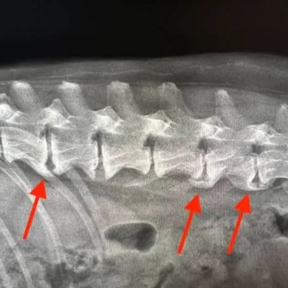 Spondyloza